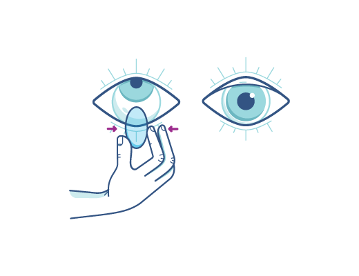 Drücken Sie die Kontaktlinse vorsichtig zusammen, um sie herauszunehmen.