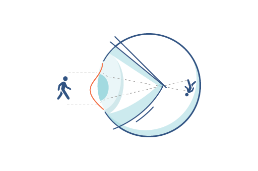 Illustration eines Auges mit Hornhautverkrümmung