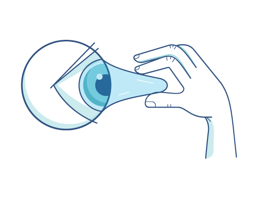 Kontaktlinsen vom Auge absetzen.