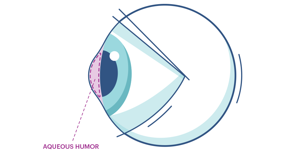 Illustration eines Auges mit Makierung der Vorderkammer