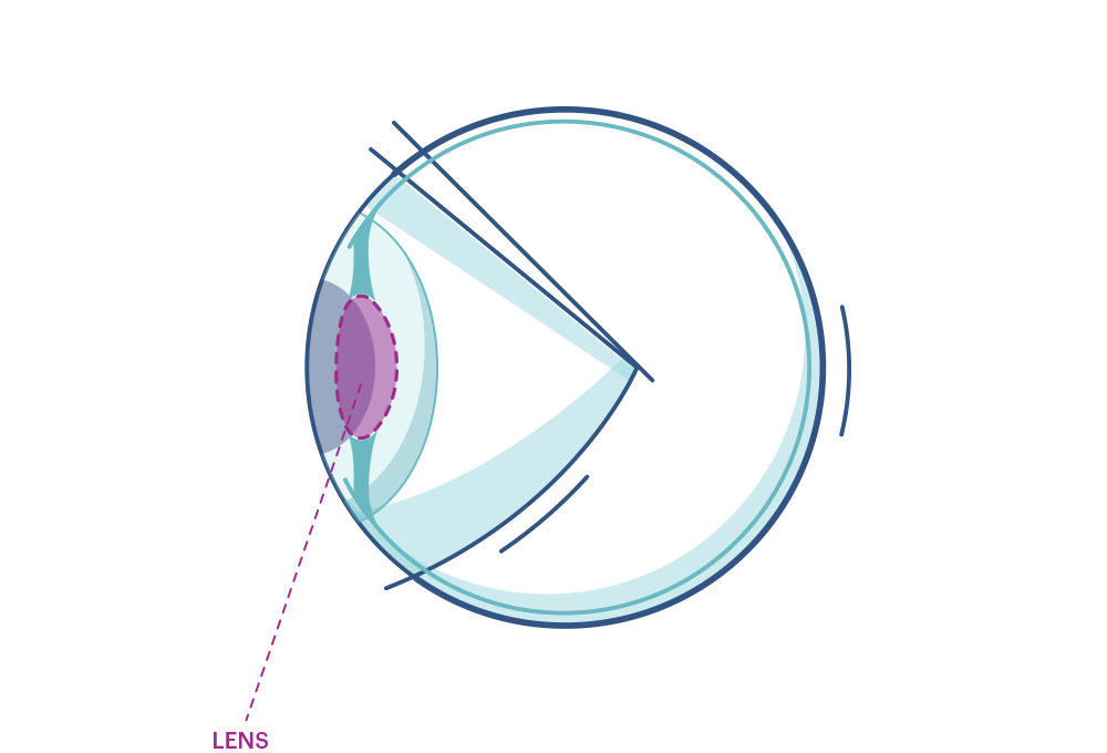 Illustration eines Auges mit Makierung der Linse 