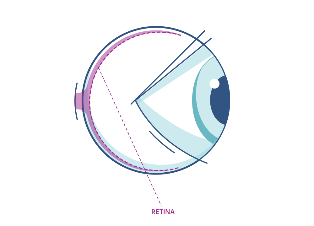 Illustration eines Auges mit Markierung der Netzhaut
