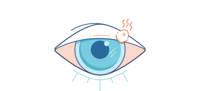 Illustration eines Gerstenkorns am Augenlid.